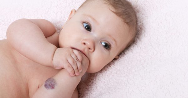 Hémangiome de l'enfance, qui tache à contrôler