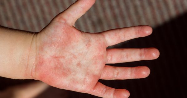 Jeux de plein air : enfants, attention à la mite processionnaire !