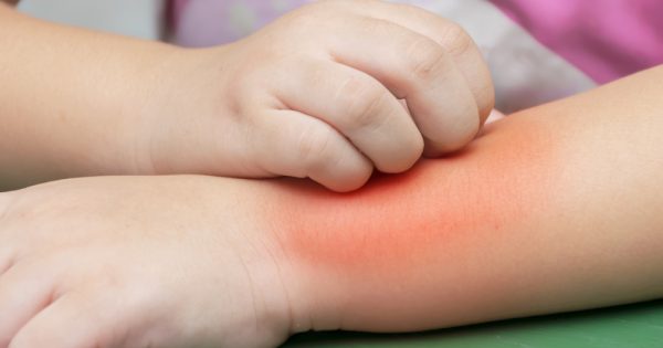 Démangeaisons chez l’enfant : le mot du pédiatre Démangeaisons chez l'enfant : le mot du pédiatre