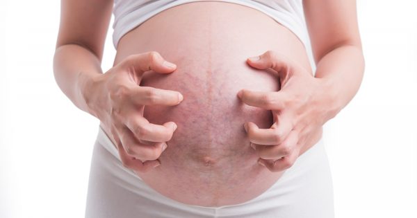 Démangeaisons diffuses pendant la grossesse, il pourrait s'agir d'une cholestase gravidique : qu'est-ce que c'est et comment la traiter ?