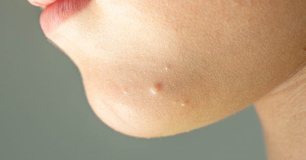 Le molluscum contagiosum chez l'enfant : ce que c'est et comment le traiter