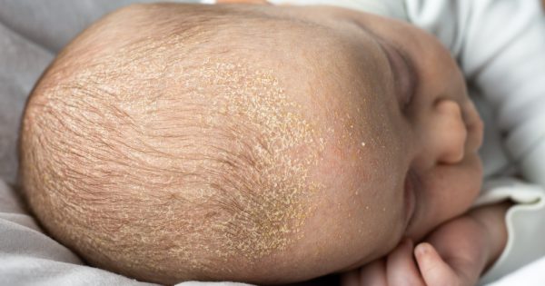 Comment combattre la croûte de lait ? Quelques remèdes naturels