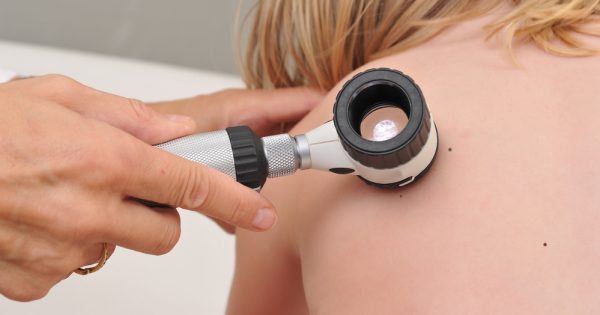 Les grains de beauté chez l'enfant : tout ce que vous devez savoir