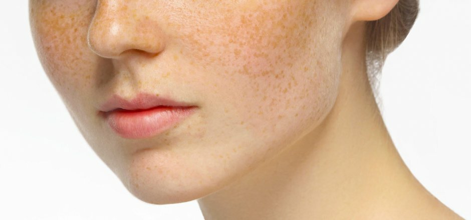 Les méthodes naturelles pour atténuer les taches de rousseur