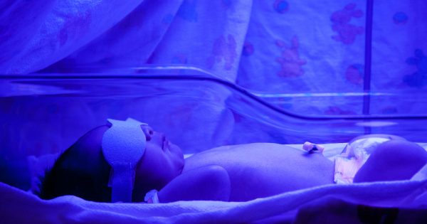 Jaunisse du nouveau-né : symptômes, causes et traitement