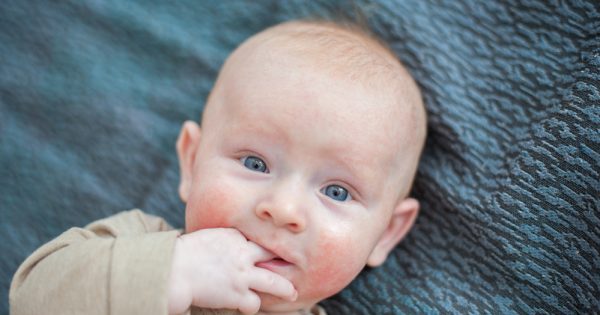 Une année d’ANDeA pour sensibiliser à la dermatite atopique Une année d'ANDeA pour sensibiliser à la dermatite atopique