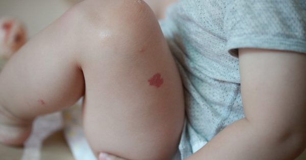 Nouveaux traitements de l’hémangiome infantile Nouveaux traitements de l'hémangiome infantile