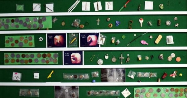 Pièces de monnaie, aimants, crochets : voici ce que les enfants ingèrent le plus souvent