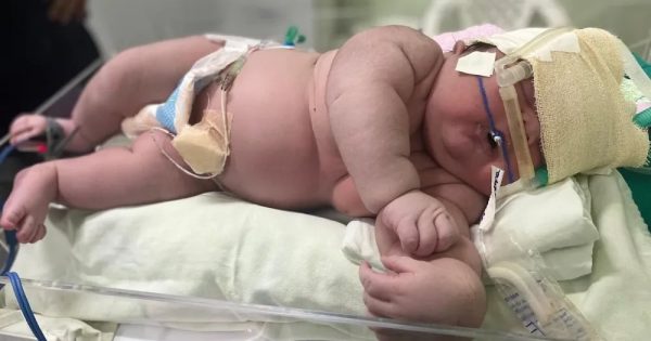 Brésil : un bébé de 7 kg est né, mais le record reste italien