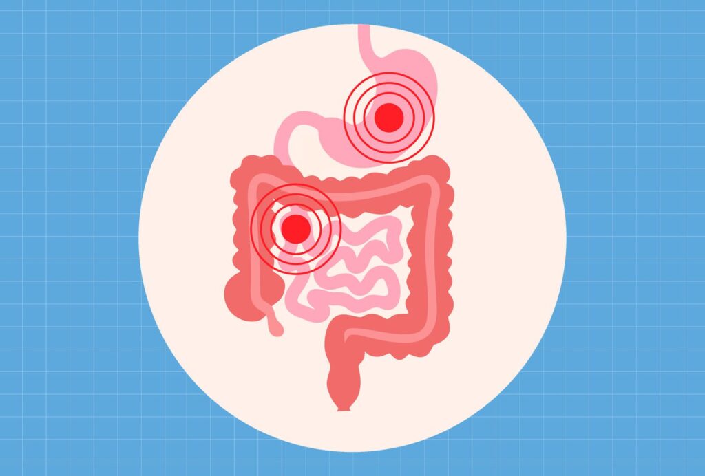 La choucroute peut réduire l’inflammation de l’intestin La choucroute peut réduire l'inflammation de l'intestin